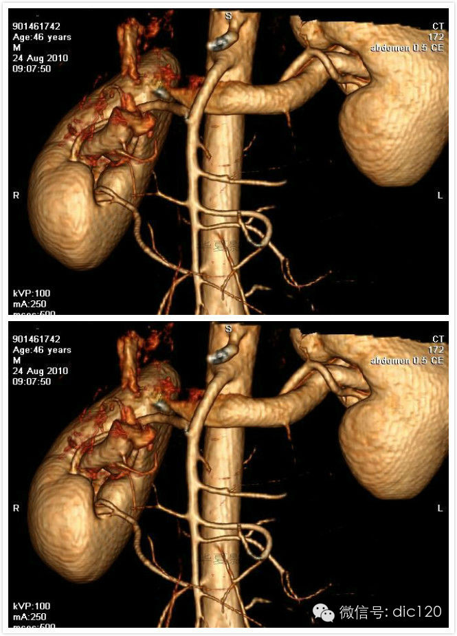 典型的胡桃夹综合症
