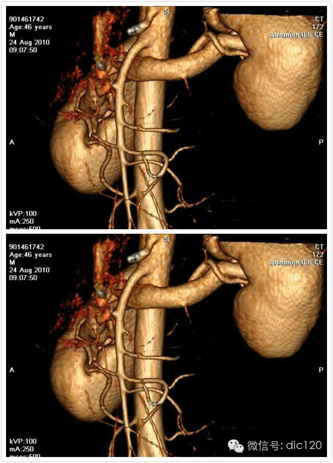 典型的胡桃夹综合症