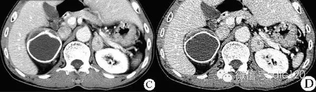 【不典型病例】肾上腺嗜铬细胞瘤——CT病例影像诊断分析