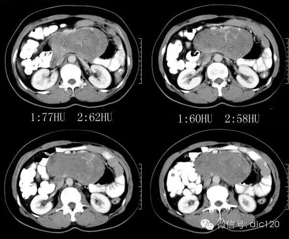 【病例】腹膜后恶性间叶组织肿瘤——CT病例影像诊断分析