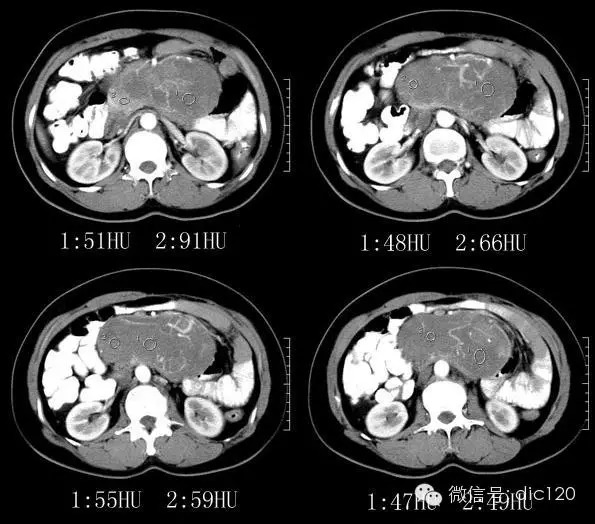 【病例】腹膜后恶性间叶组织肿瘤——CT病例影像诊断分析