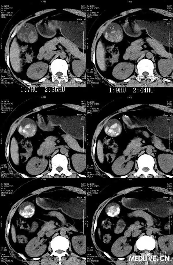 【病例】胆囊炎、胆囊结石一例CT病例讨论
