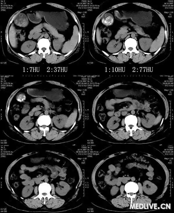 【病例】胆囊炎、胆囊结石一例CT病例讨论