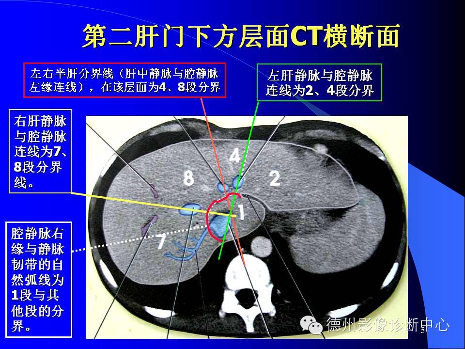 肝脏8段分法的影像学解剖