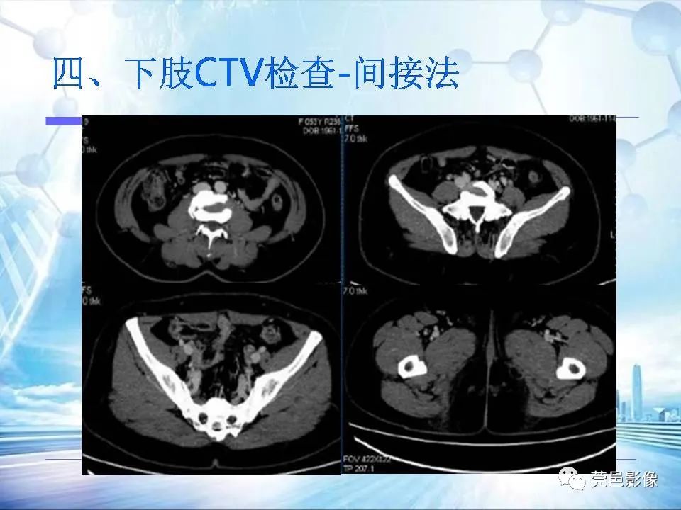 【PPT】浅谈下肢静脉CTV的应用体会-33