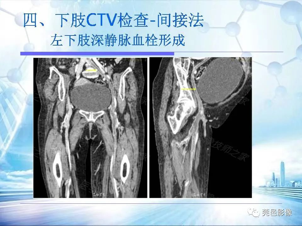 【PPT】浅谈下肢静脉CTV的应用体会-35