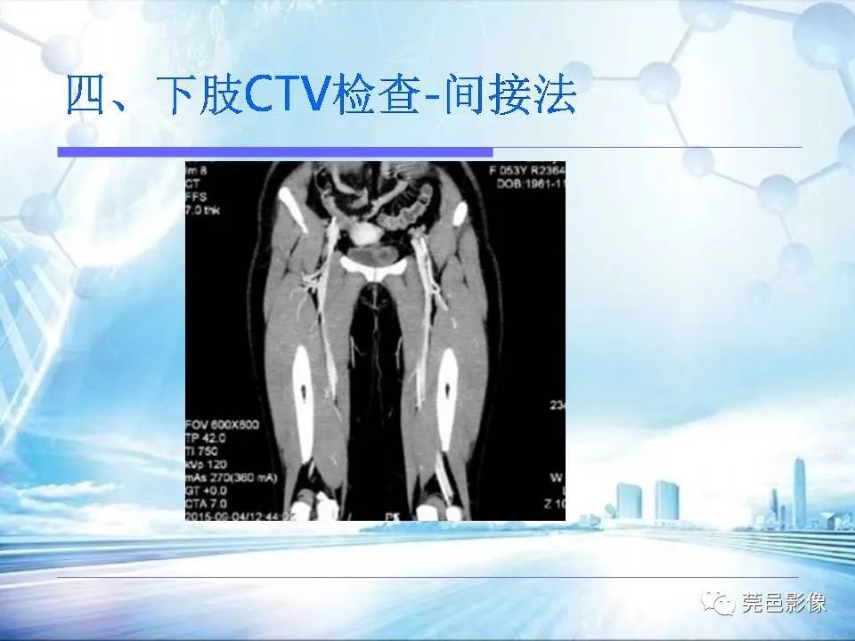 【PPT】浅谈下肢静脉CTV的应用体会-34