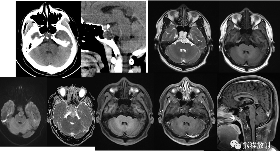 【病例】斜坡 & 骶骨脊索瘤各1例CT及MR-3
