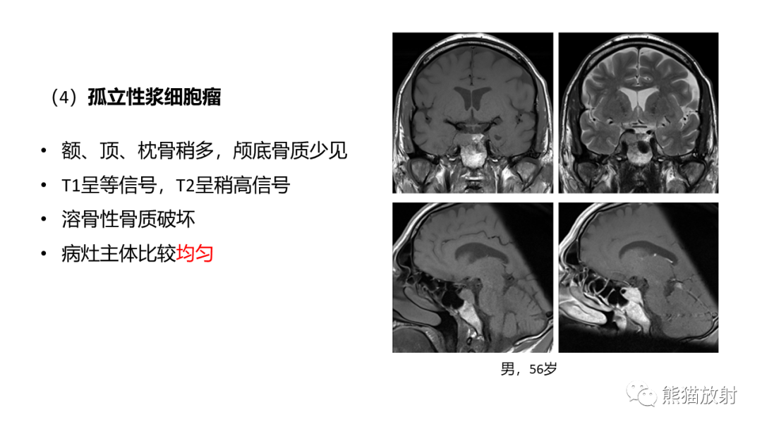 【病例】斜坡 & 骶骨脊索瘤各1例CT及MR-20