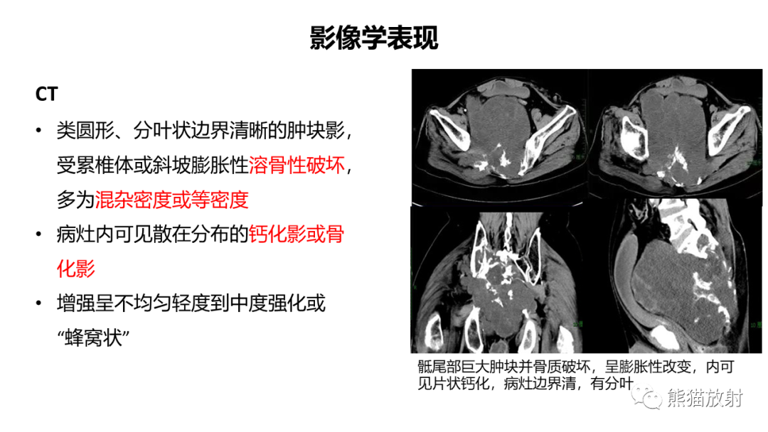 【病例】斜坡 & 骶骨脊索瘤各1例CT及MR-13