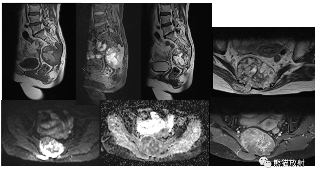 【病例】斜坡 & 骶骨脊索瘤各1例CT及MR-6
