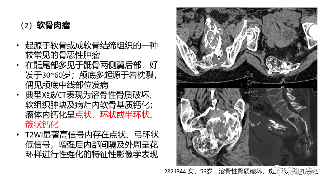 【病例】斜坡 & 骶骨脊索瘤各1例CT及MR-18