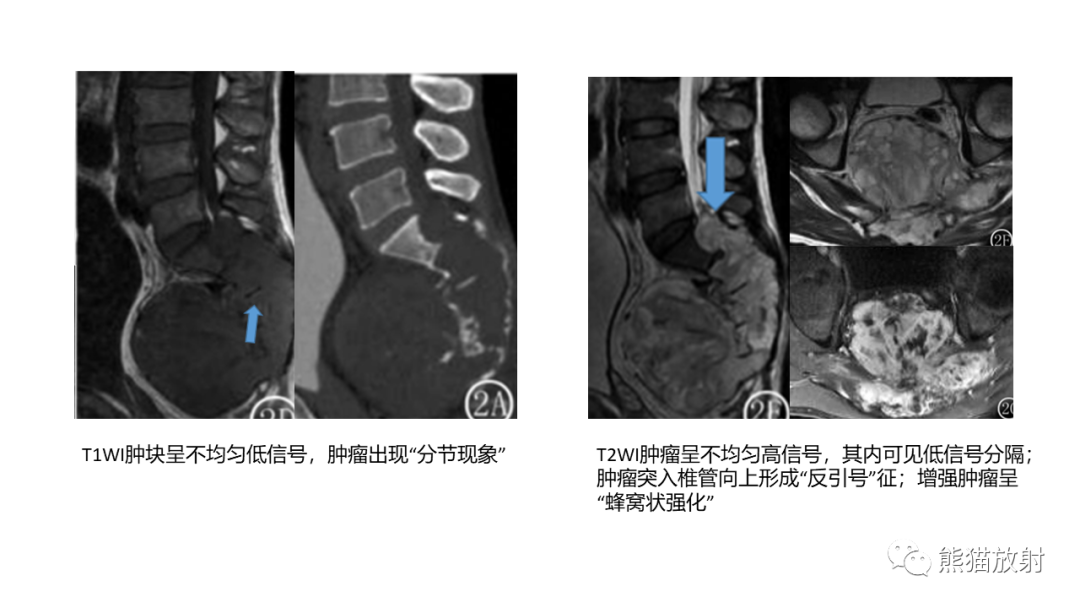 【病例】斜坡 & 骶骨脊索瘤各1例CT及MR-16