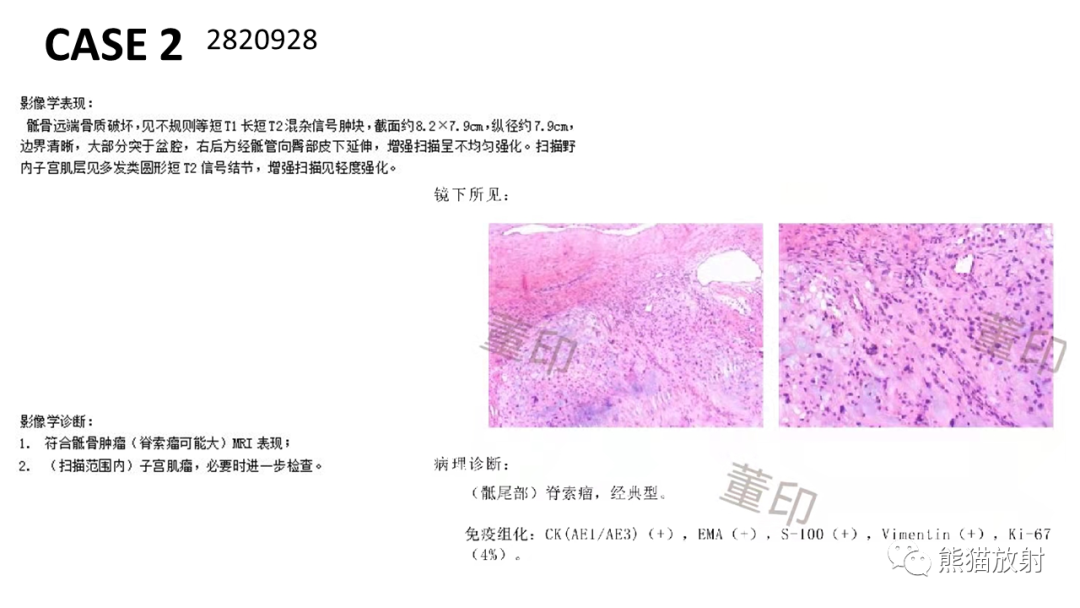 【病例】斜坡 & 骶骨脊索瘤各1例CT及MR-9