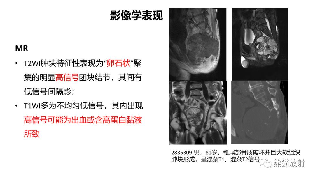 【病例】斜坡 & 骶骨脊索瘤各1例CT及MR-14