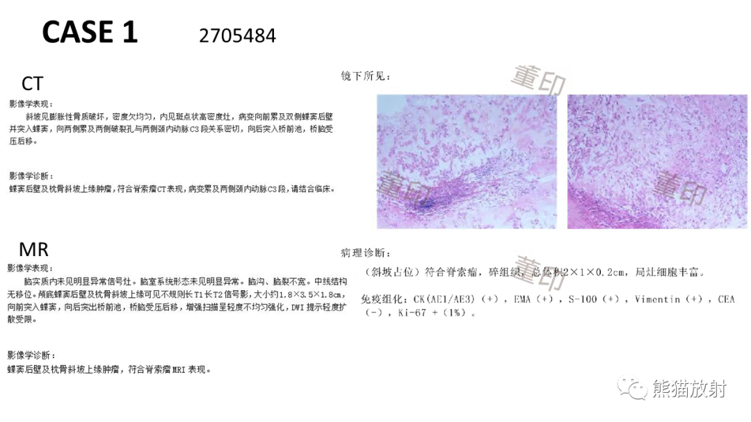 【病例】斜坡 & 骶骨脊索瘤各1例CT及MR-8