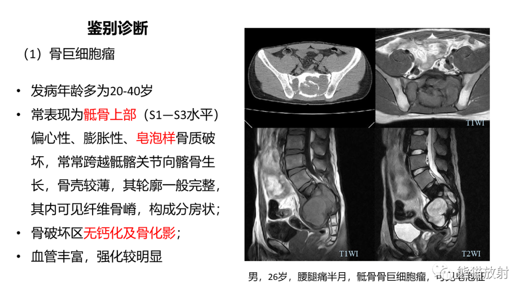 【病例】斜坡 & 骶骨脊索瘤各1例CT及MR-17