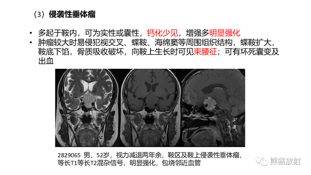 【病例】斜坡 & 骶骨脊索瘤各1例CT及MR-19