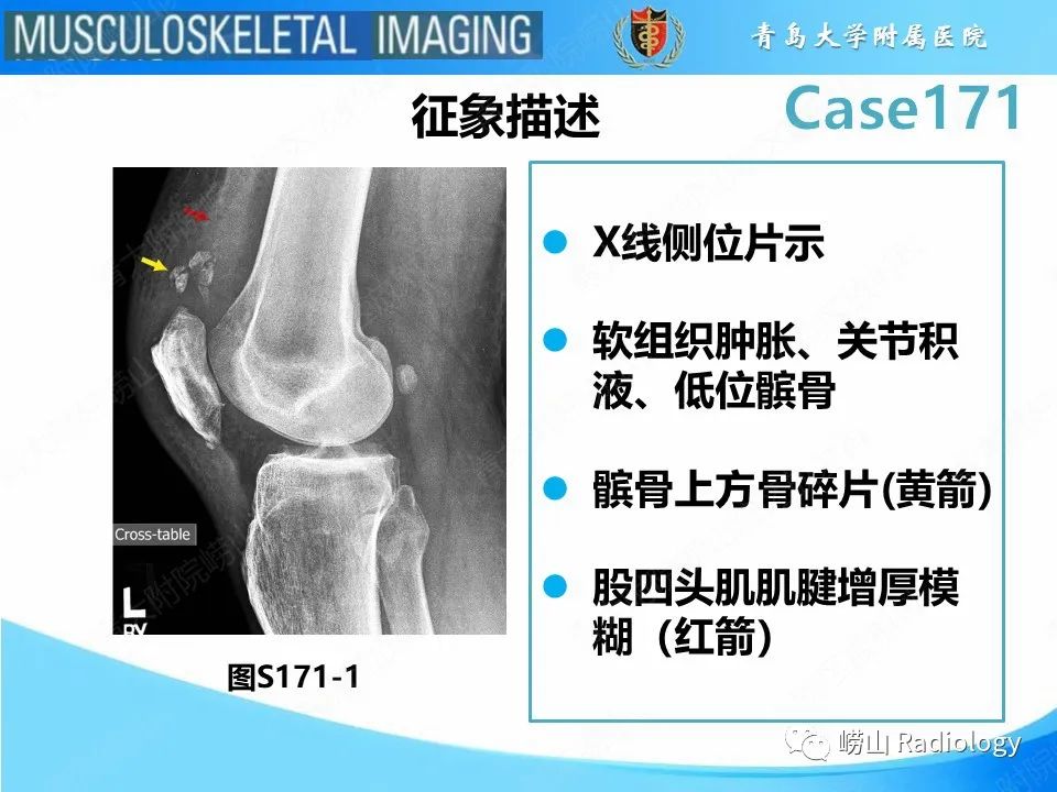 【PPT】股四头肌肌腱断裂-16