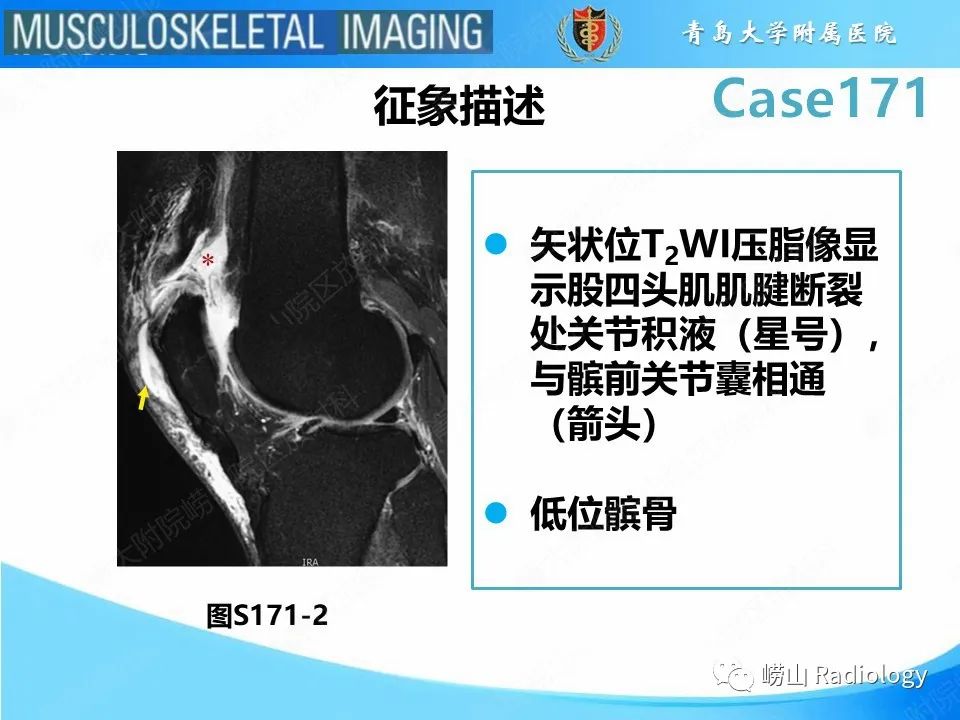【PPT】股四头肌肌腱断裂-17