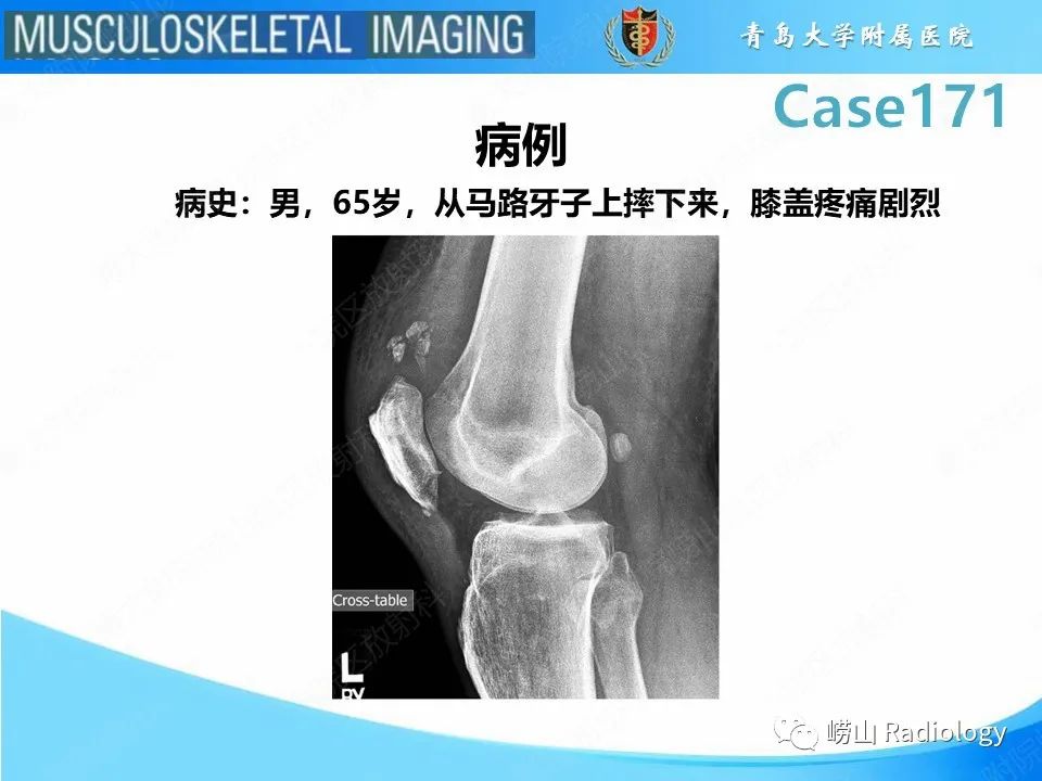 【PPT】股四头肌肌腱断裂-2