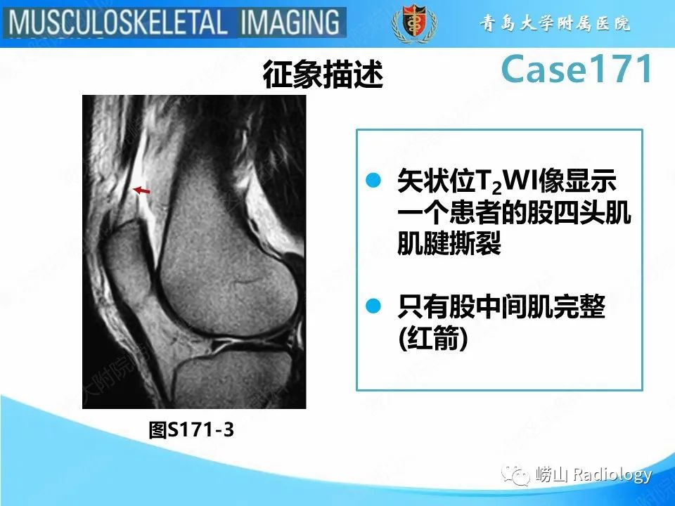 【PPT】股四头肌肌腱断裂-18