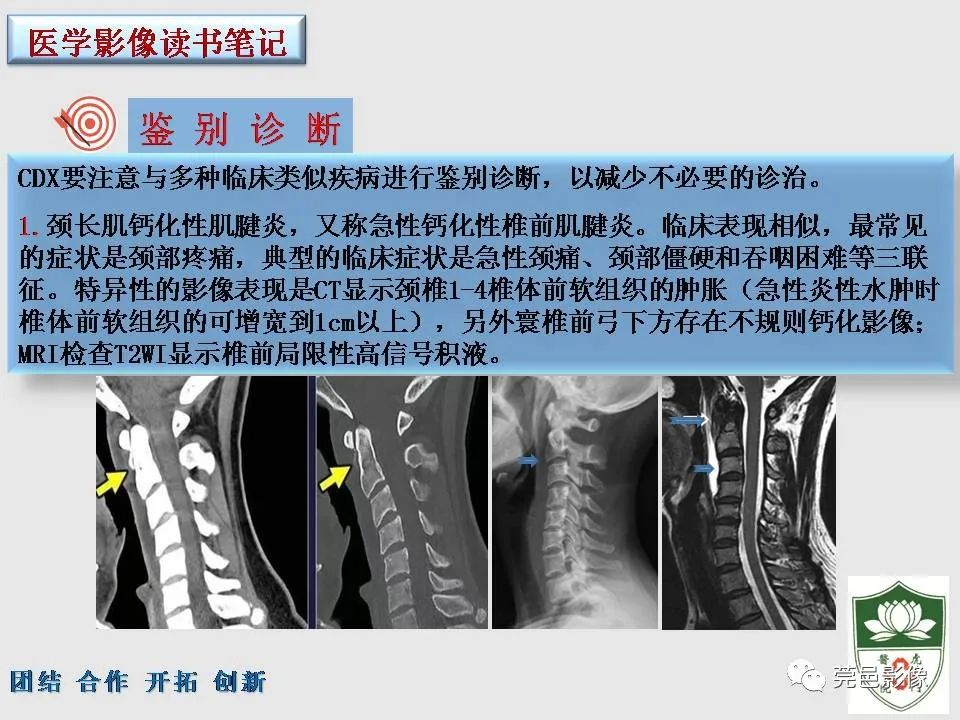 【PPT】齿状突加冠综合征-15