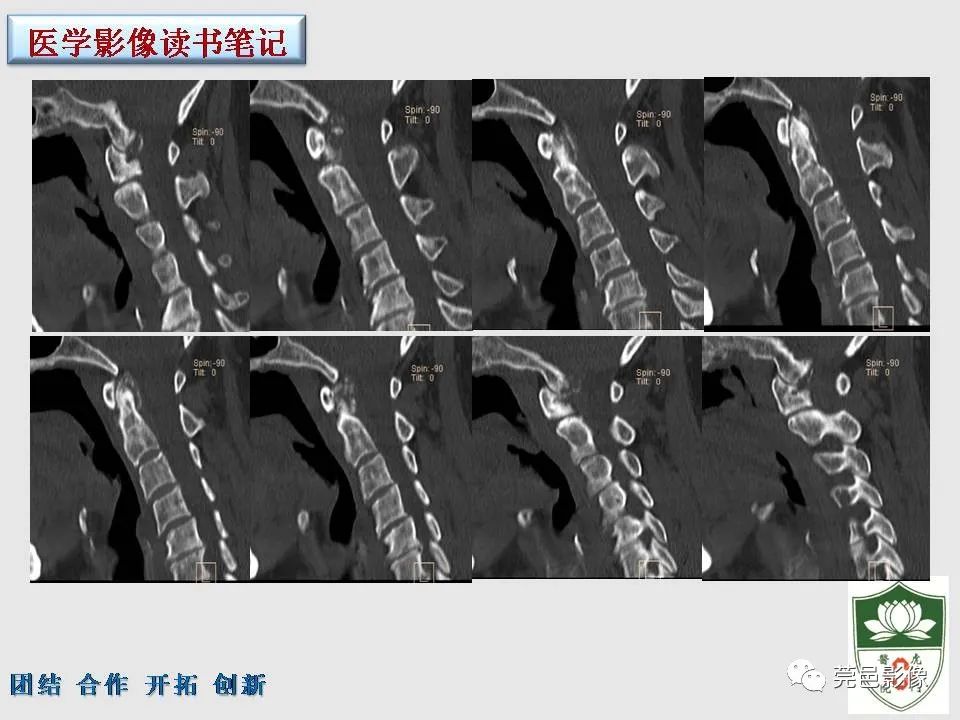 【PPT】齿状突加冠综合征-4