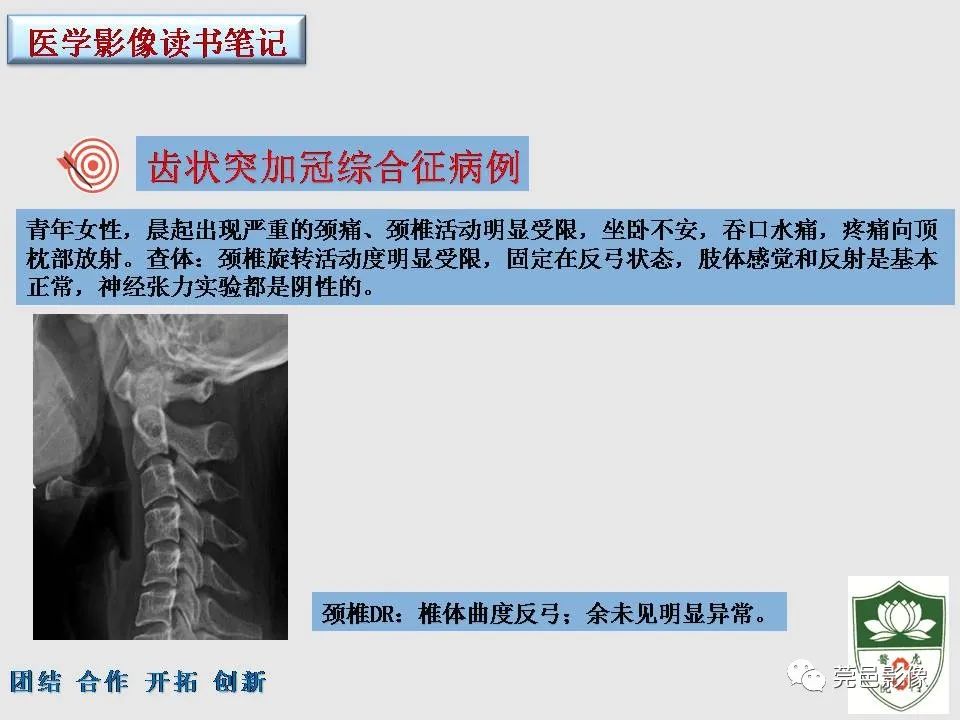 【PPT】齿状突加冠综合征-12