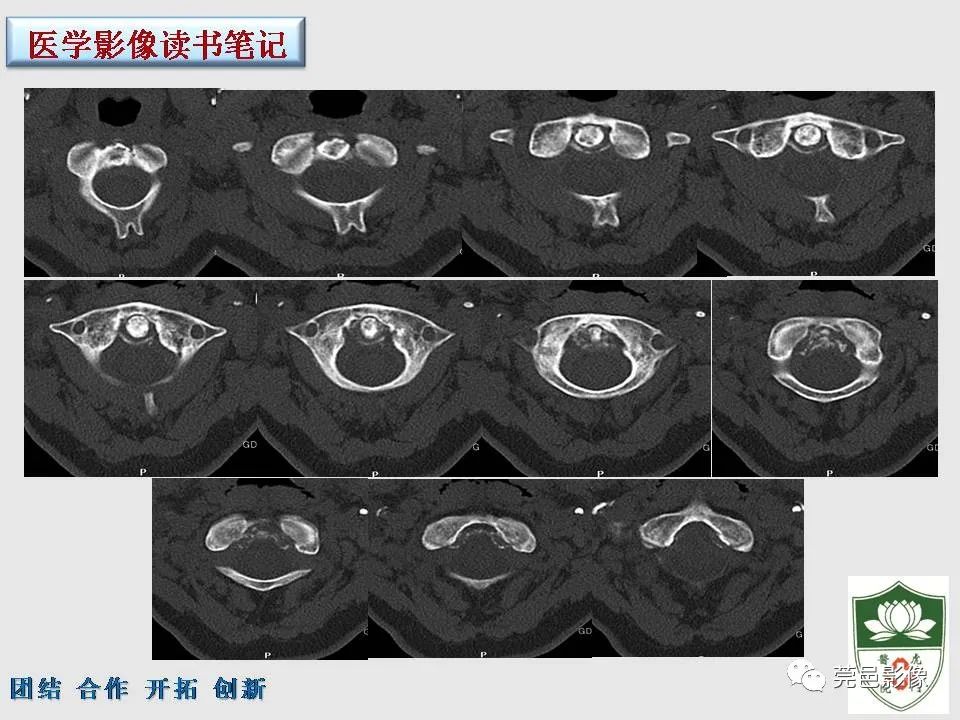 【PPT】齿状突加冠综合征-3