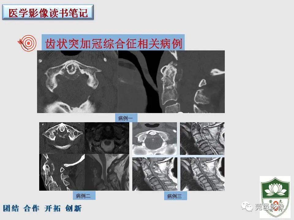 【PPT】齿状突加冠综合征-14