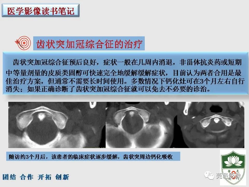 【PPT】齿状突加冠综合征-17