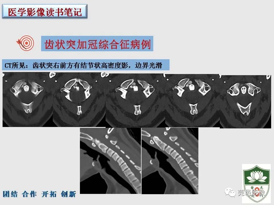 【PPT】齿状突加冠综合征-13