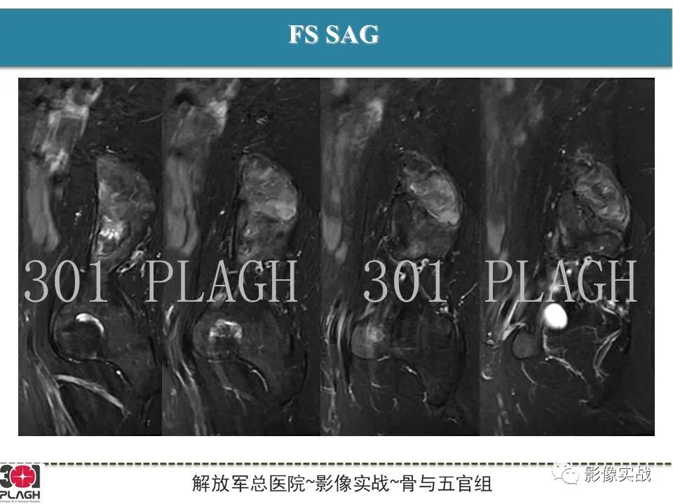 【病例】骨纤维结构不良1例X线MR影像-7