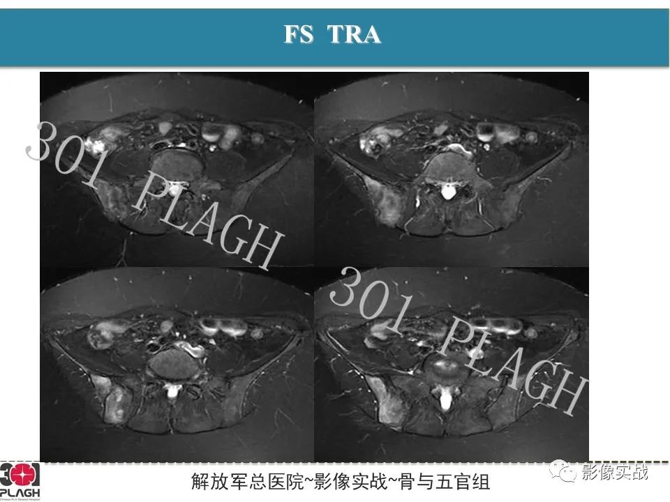 【病例】骨纤维结构不良1例X线MR影像-5