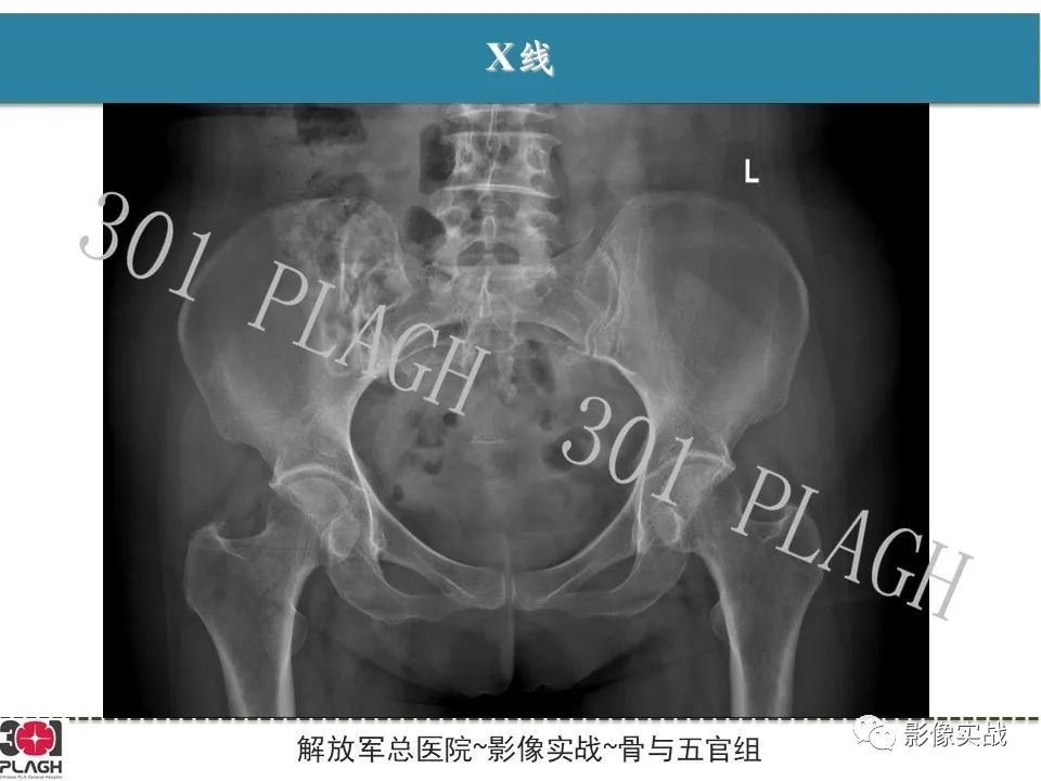 【病例】骨纤维结构不良1例X线MR影像-3