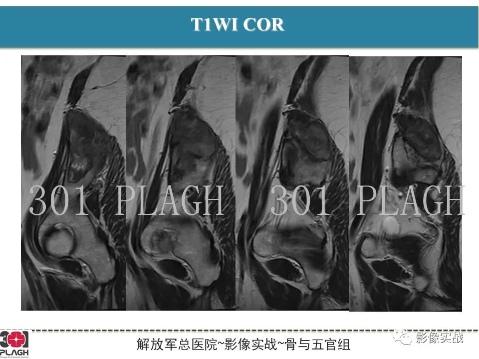 【病例】骨纤维结构不良1例X线MR影像-8