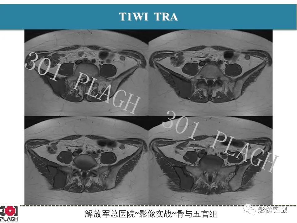 【病例】骨纤维结构不良1例X线MR影像-4