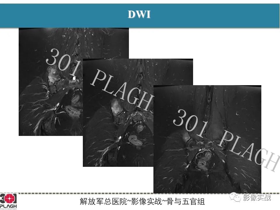 【病例】骨纤维结构不良1例X线MR影像-6