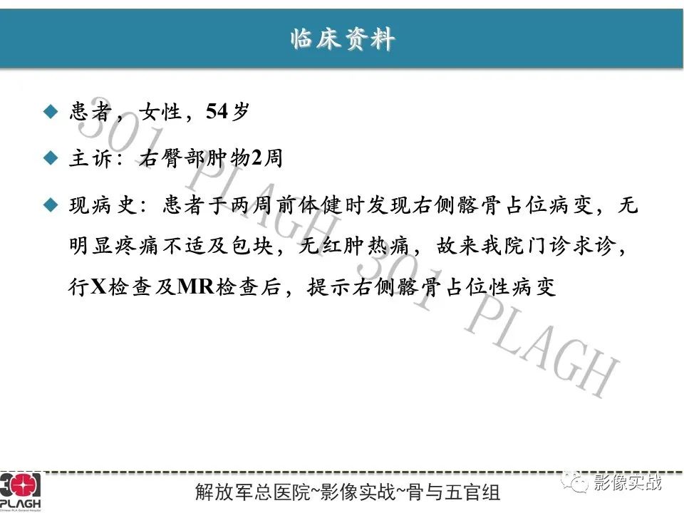 【病例】骨纤维结构不良1例X线MR影像-2