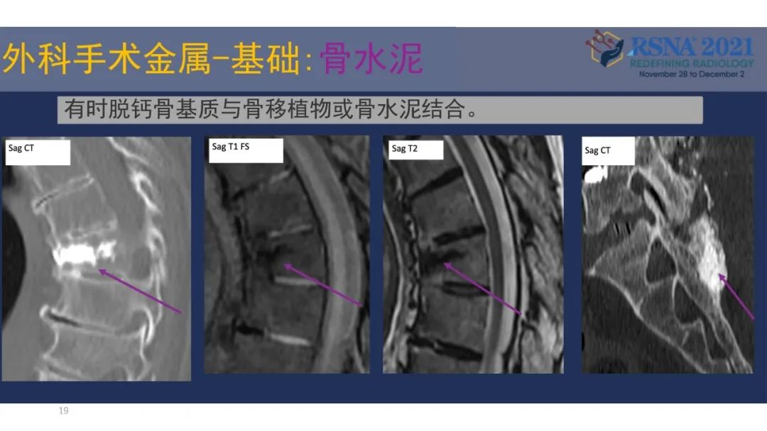 【PPT】术后脊柱-为了外科医生和患者安全着想的金属图像-19