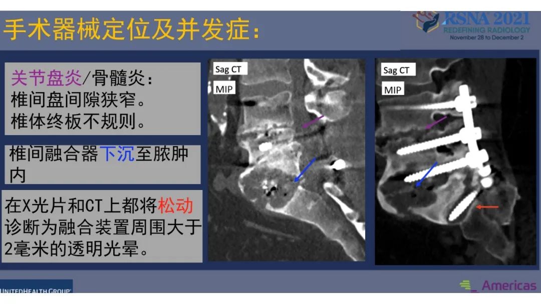 【PPT】术后脊柱-为了外科医生和患者安全着想的金属图像-31