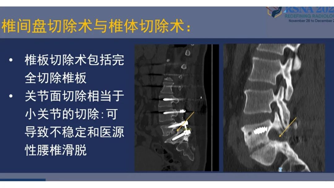 【PPT】术后脊柱-为了外科医生和患者安全着想的金属图像-11