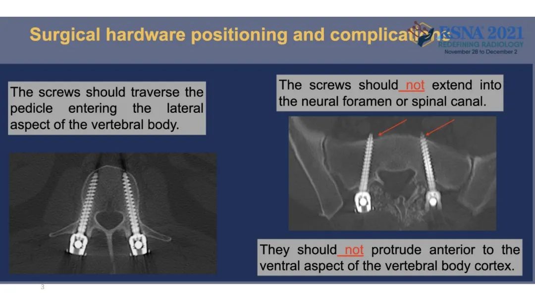 【PPT】术后脊柱-为了外科医生和患者安全着想的金属图像-26