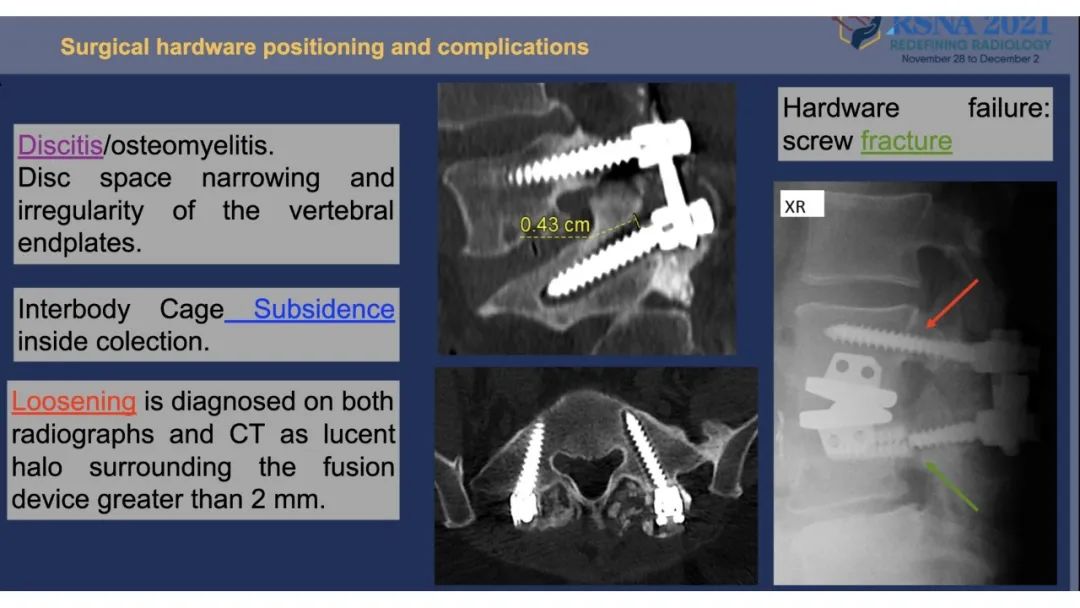 【PPT】术后脊柱-为了外科医生和患者安全着想的金属图像-34