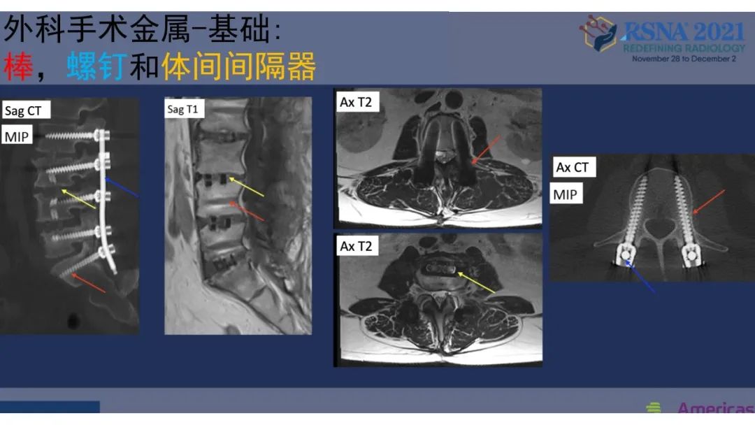 【PPT】术后脊柱-为了外科医生和患者安全着想的金属图像-17