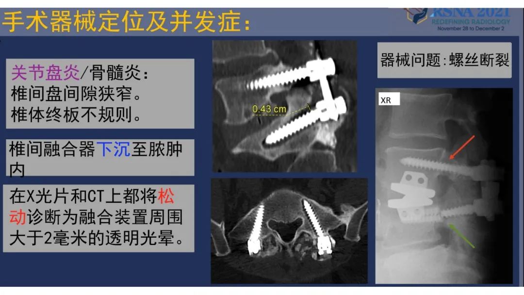 【PPT】术后脊柱-为了外科医生和患者安全着想的金属图像-33