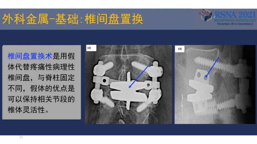 【PPT】术后脊柱-为了外科医生和患者安全着想的金属图像-21