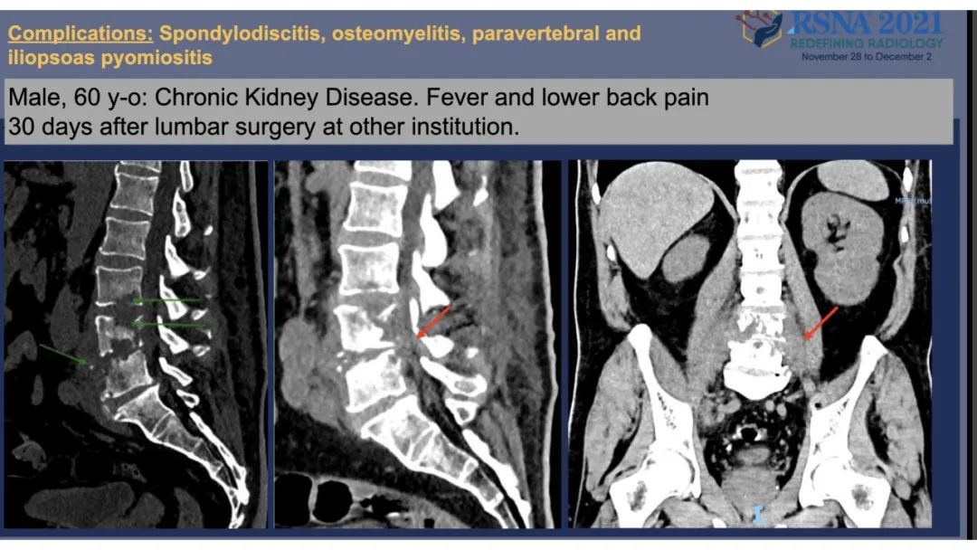 【PPT】术后脊柱-为了外科医生和患者安全着想的金属图像-44