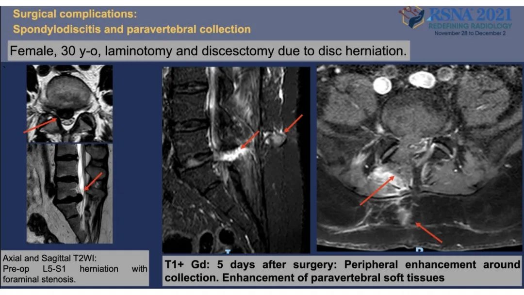 【PPT】术后脊柱-为了外科医生和患者安全着想的金属图像-42